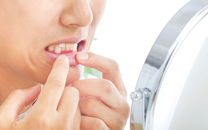 お口のやけどの注意点:水ぶくれや皮むけはそのままに