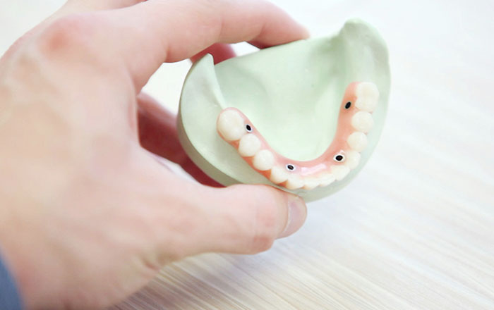 プロアーチの手術の流れ：最終的な人工歯を入れる