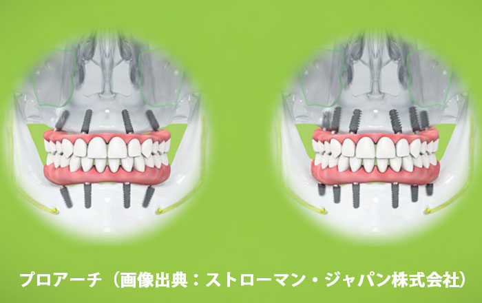 そもそもプロアーチ（Pro Arch）って？