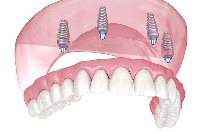 プロアーチとは？