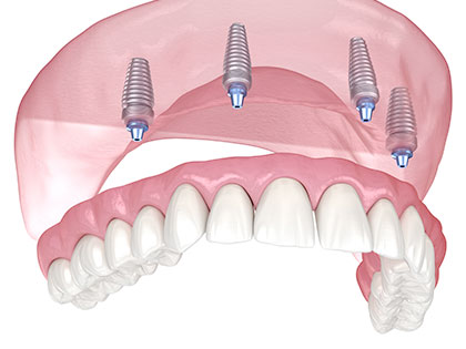プロアーチとは？