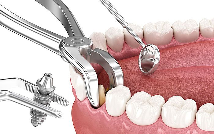 即時荷重インプラント・抜歯即時インプラントの治療の流れ