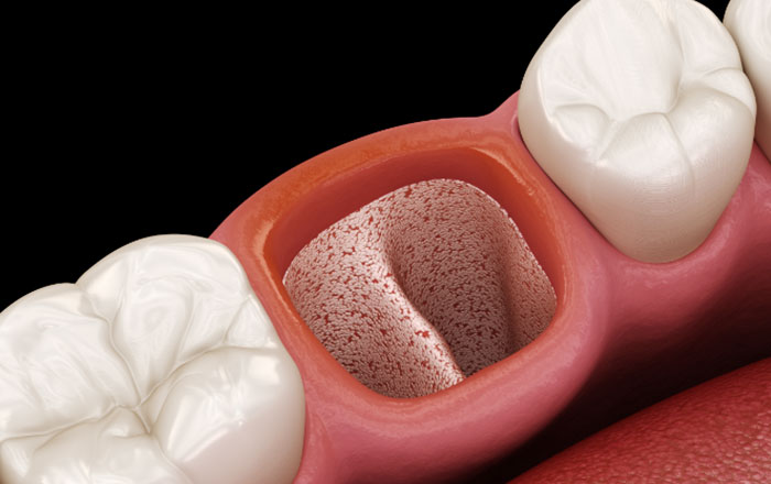 抜歯即時インプラントは「歯を抜いたその日にインプラントを埋める方法」