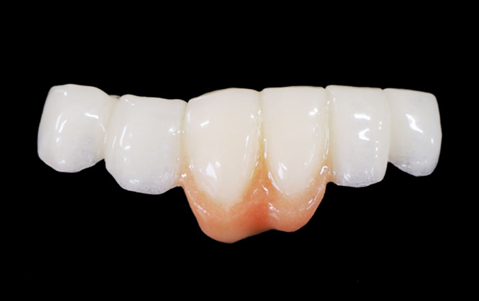 即時荷重インプラントは、「インプラントを埋めた直後から仮歯で噛めるようにする方法」