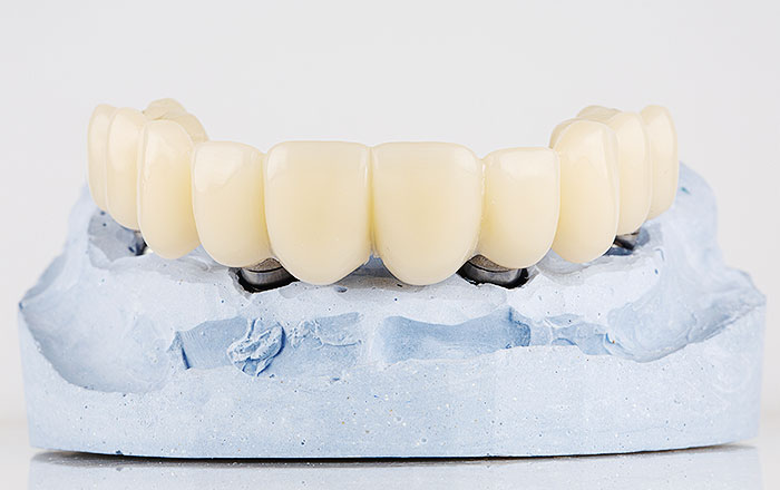 即時荷重インプラントの大きなメリットは、歯がない期間を短くできること