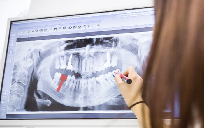 抜歯即時インプラントと即時荷重インプラントが可能になる条件:骨の状態が十分であること