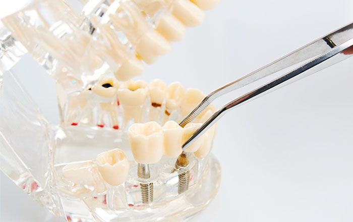 抜歯即時インプラント・即時荷重インプラントとは?