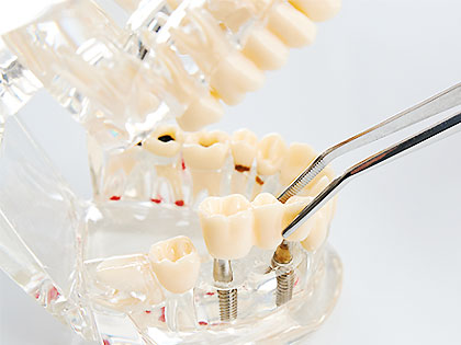 抜歯即時インプラント・即時荷重インプラントとは?