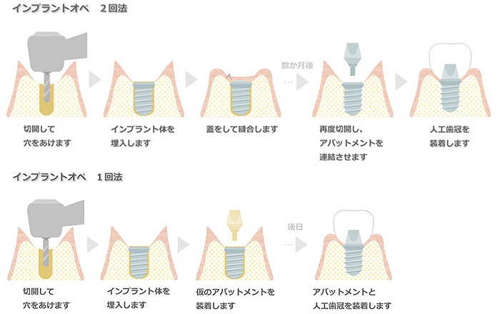 インプラント治療の流れ：5.インプラント埋入手術
