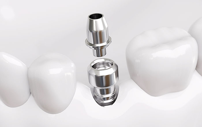 アバットメントの装着