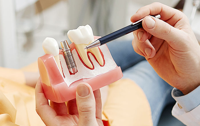 治療の流れを知ってインプラントへの理解を深めよう