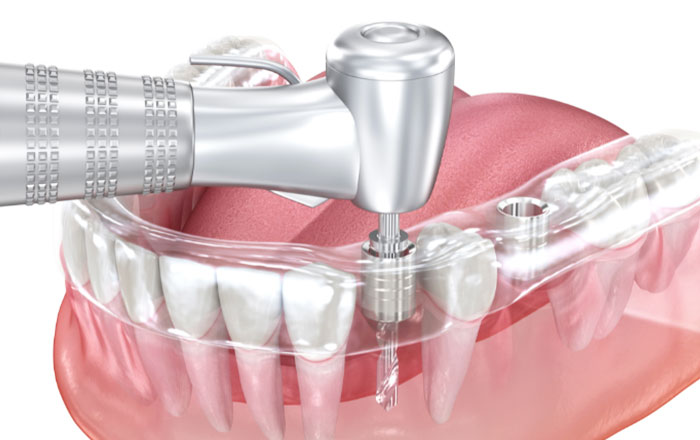 サージカルガイドで安全性・確実性を高めたインプラント治療を