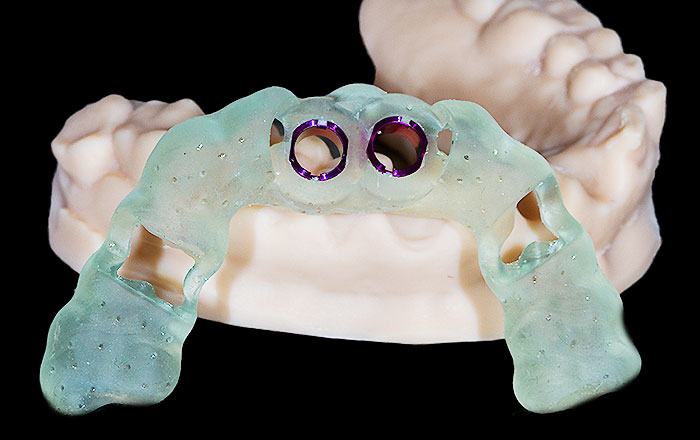 サージカルガイドとは？