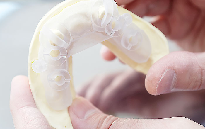 サージカルガイドの使用が推奨されるケース