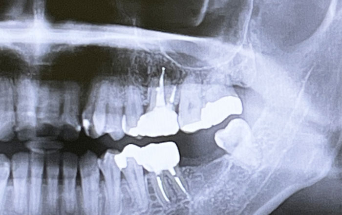 サージカルガイドを使う4つのメリット：骨の厚み・傾きに合わせて、ミリ単位で最適な位置へ埋入できる