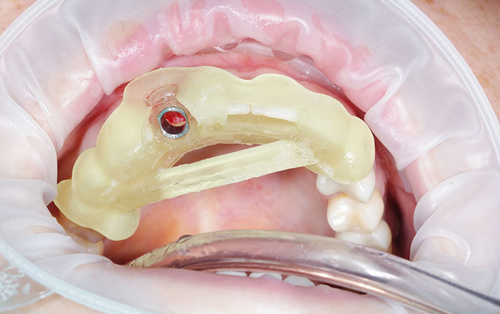 サージカルガイドを使う4つのメリット：切開が小さく済むため、痛み・腫れを軽減しやすい