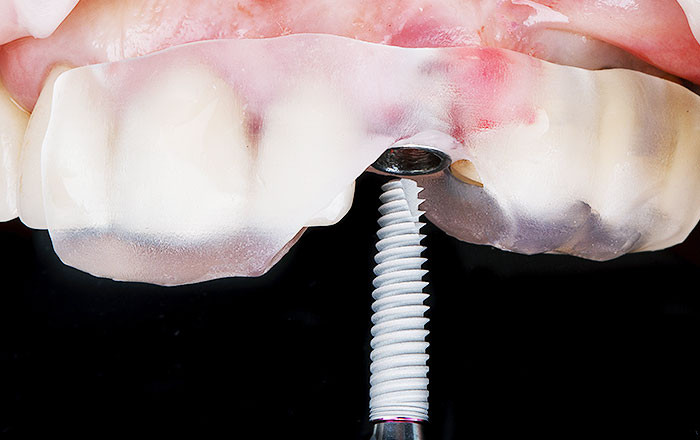 シミュレーションで決定した治療計画をもとに、サージカルガイドを作製します。そして手術当日に、サージカルガイドを口に装着し、ガイドに沿った的確な位置へインプラントを埋入します。