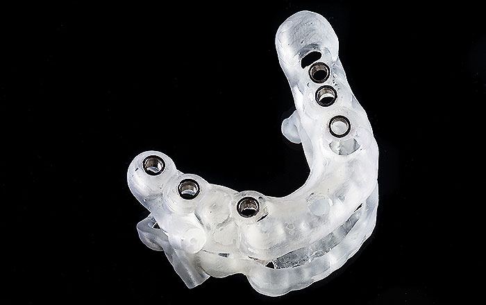 インプラント治療の安全性を高める『サージカルガイド』とは？