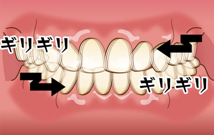 グラインディング(歯をギリギリ擦り合わせる)