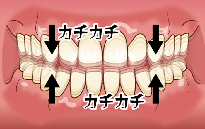 タッピング(歯をカチカチ鳴らす)