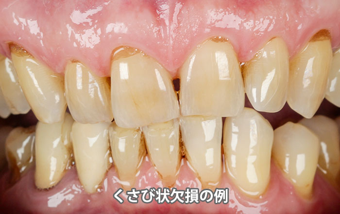 くさび状欠損（WSD：Wedge-Shaped Defect）