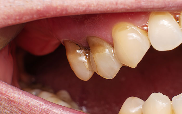 NCCL（Non-Carious Cervical Lesions）とは非う蝕性歯頚部病変