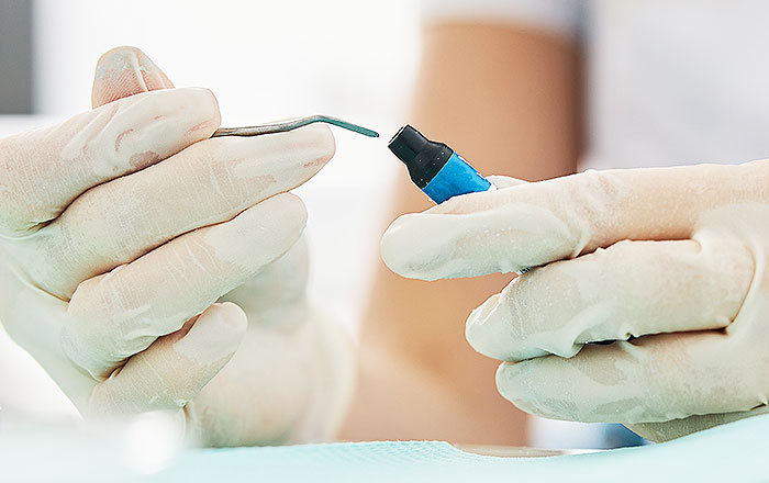 NCCLを治すには治療が必要～コンポジットレジンの充填