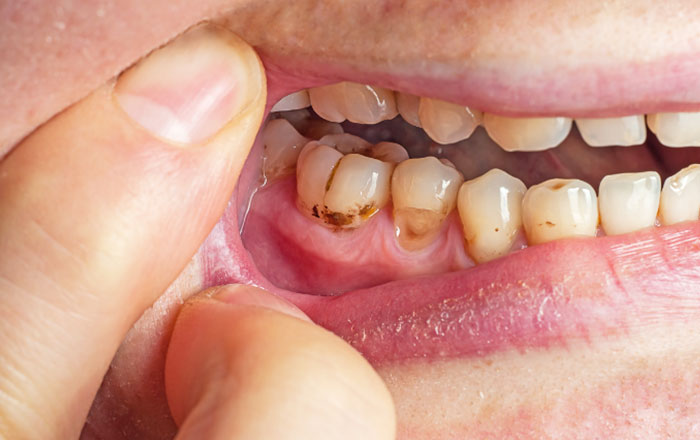 虫歯じゃないのに歯の根元が削れるNCCL（非う蝕性歯頚部病変）とは？