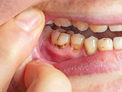 虫歯ではないのに歯の根元が削れるNCCL（非う蝕性歯頚部病変）とは？